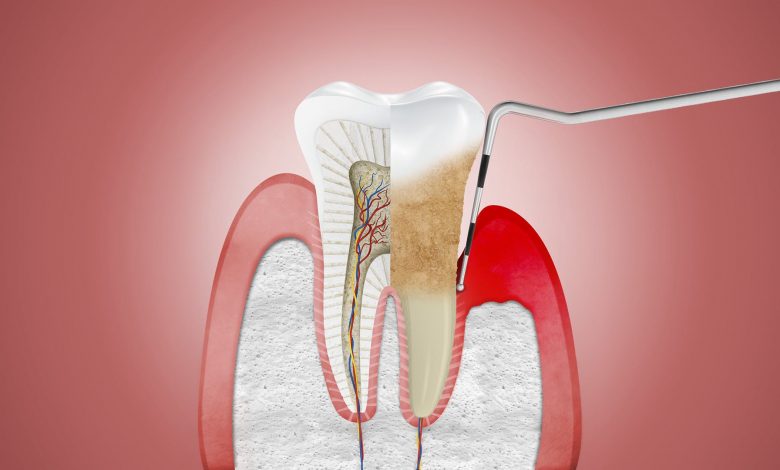 Periodontal Disease & Heart Disease: Is There a Connection?