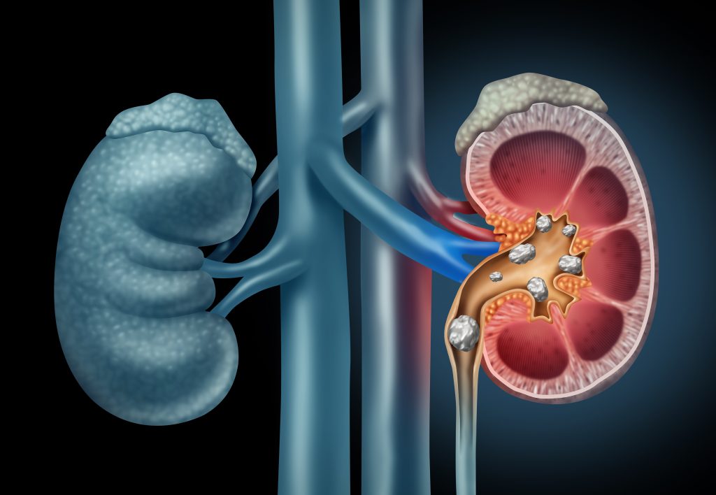 What are kidney stones and how to prevent them?